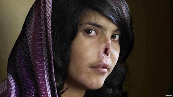 Afghan Woman's Nose Sliced off By Her Husband